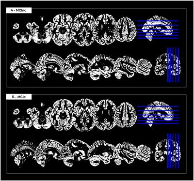 Comparison of Transfer Learning and Conventional Machine Learning Applied to Structural Brain MRI for the Early Diagnosis and Prognosis of Alzheimer's Disease